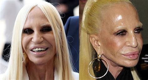 Donatella Versace Celebrities Then And Now Celebrity Plastic Surgery