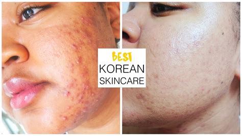 best korean toner for acne prone skin