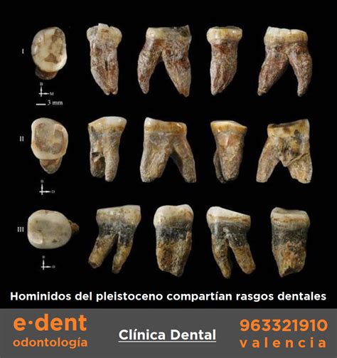 hominidos  rasgos dentales comunes implantes dentales valencia