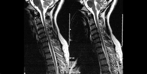 cervical spinal stenosis dr  heffez neurological surgeon