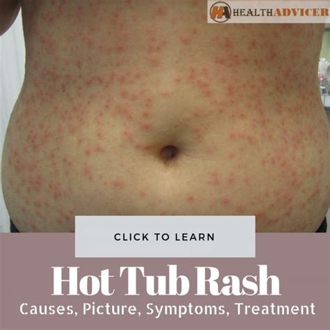 photos how to get rid of hot tub rash bacteria mobile legends