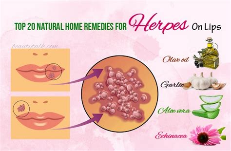 best cure for herpes in the mouth — herpes free me