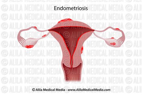 Alila Medical Media Female Reproductive System Images