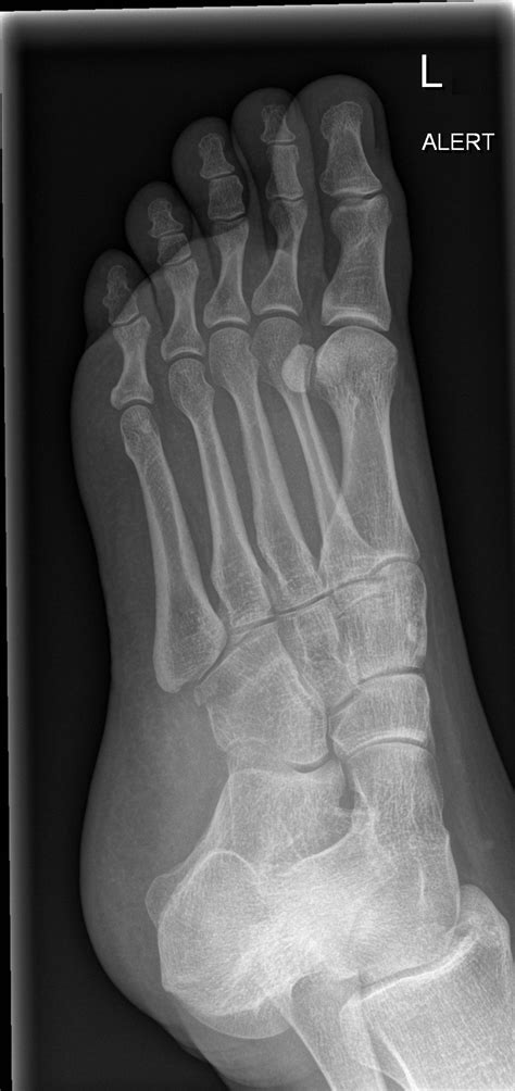 Cuboid Fracture Image