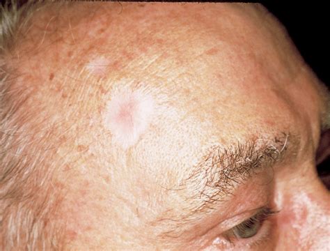 early stage skin cancer  face symptoms steve