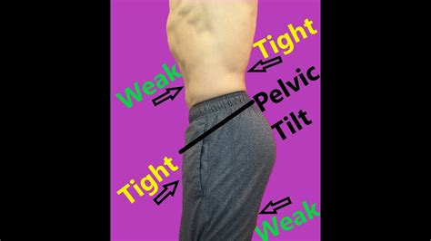 Anterior Pelvic Tilt 30 Day Correction Plan Youtube