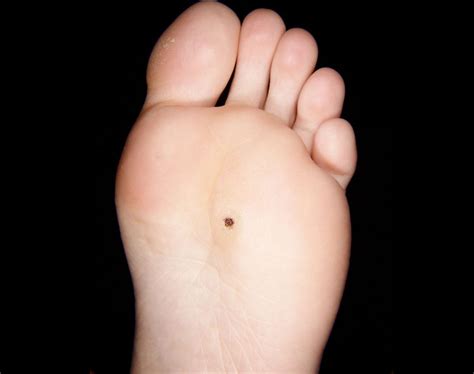 warts orange county foot and ankle doctor