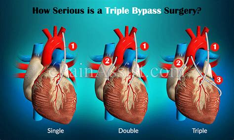 how serious is a triple bypass surgery