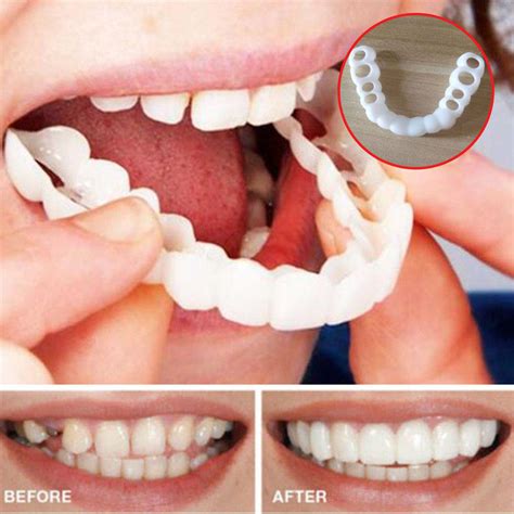 Silicone Tooth Orthodontic Braces Dental Fake Teeth Straight Perfect