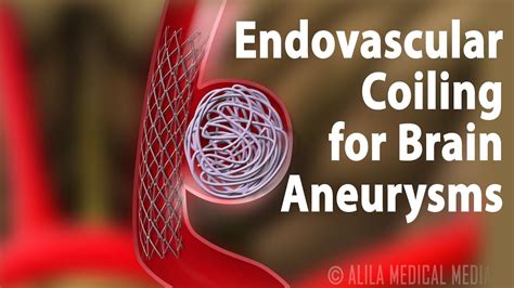 endovascular coiling  brain aneurysm animation youtube