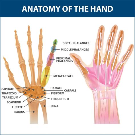 rheumatoid arthritis   hand florida orthopaeidic