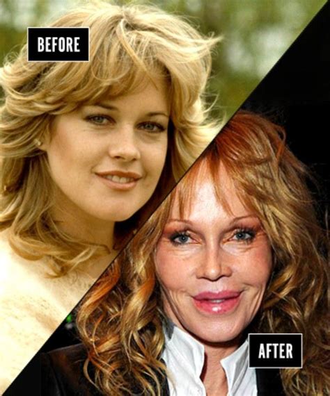 251 Best Images About Celebrity Plastic Surgery On