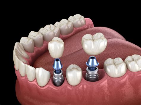 dental implants   creekview dental
