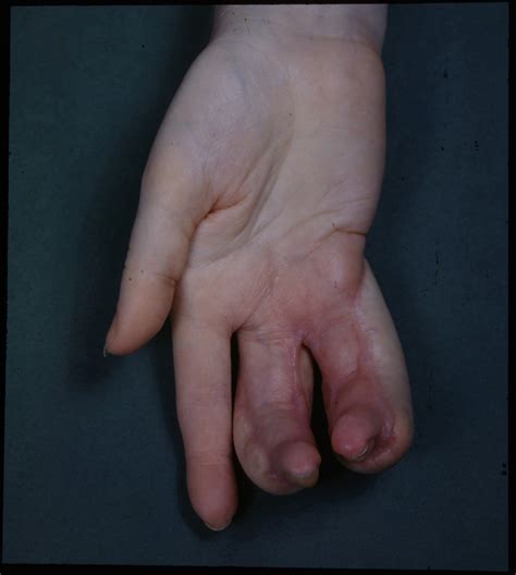 filedeformity  hand due   ray burnsjpg wikimedia commons