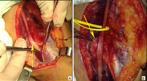 Surgical Exploration Of The Cubital Tunnel A Thickening