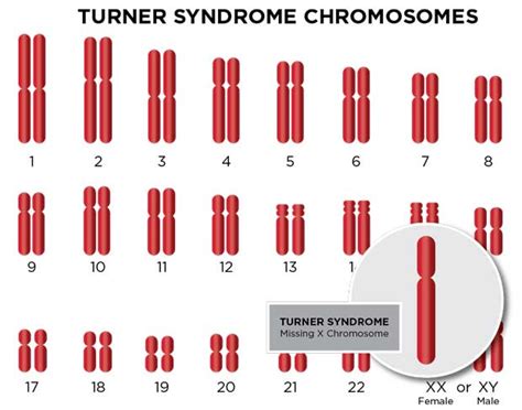 Monosomy X Turner Syndrome Diagnosis And Treatment Ssm Health