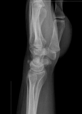 playlist wrist triquetral fractures  dr david luong