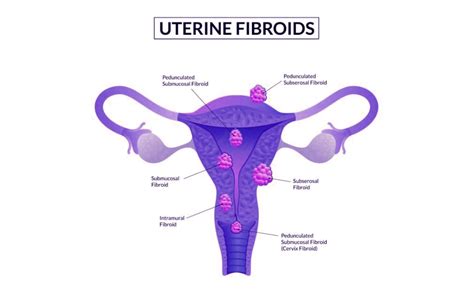 myomectomy surgery for uterine fibroids removal uterine fibroid
