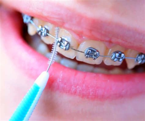 cleaning  teeth  braces specialist orthodontics treatment
