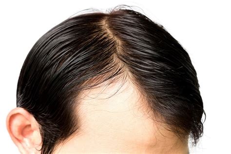 receding hairline  men  treatments