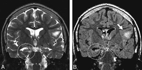 Hippocampal Abnormalities In An Mr Imaging Series Of Patients With