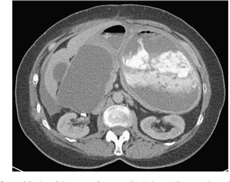 figure   transduodenal drainage   malignant ovarian pseudocyst