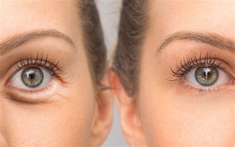eye wrinkles age factor  treatments prevention skinkraft