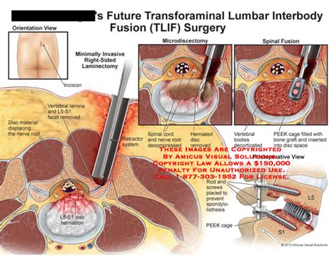 Future Transforaminal Lumbar Interbody Fusion Tlif Surgery