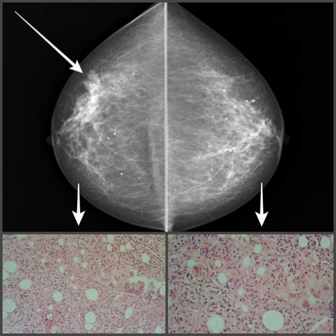 69 Year Old Female Presented With A Firm 2cm Lump With Associated Skin