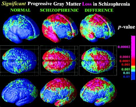 mapping adolescent brain change reveals dynamic wave  accelerated