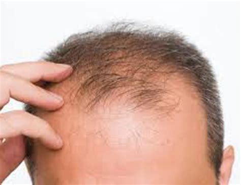main   hair loss srs hair clinic  zealand