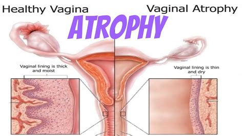 atrophy physiology pathology explained youtube