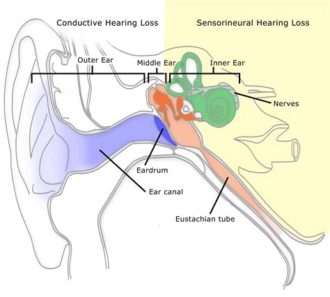 hearing loss fix  ears