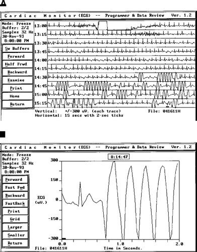 The Etiology Of Syncope In Patients With Negative Tilt Table And