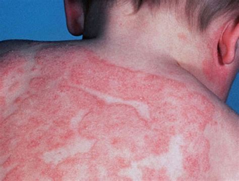 beneficial treatments  dermatitis health cautions