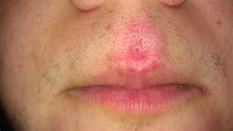i have a rash and white bumps above upper lip the rash comes