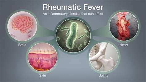 rheumatic fever symptoms   treatment scientific animations