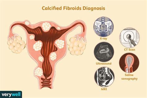 calcified fibroids symptoms pictures treatment