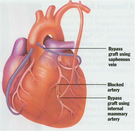 heart bypass page   problem