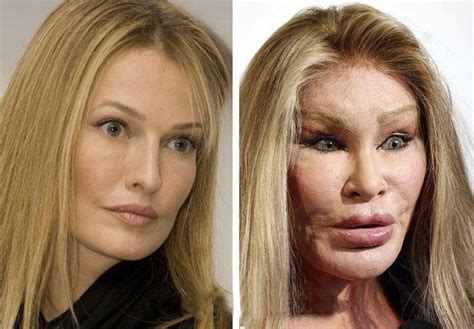6 Celebrity Plastic Surgeries Gone Wrong Prominente