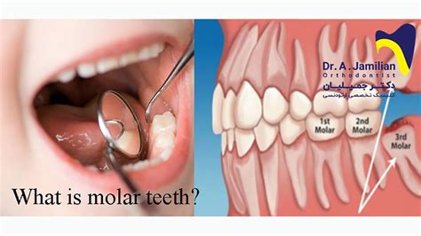 molar teeth dr jamilian