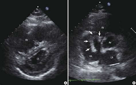 initial transthoracic echocardiography tte image   shape  lv  scientific