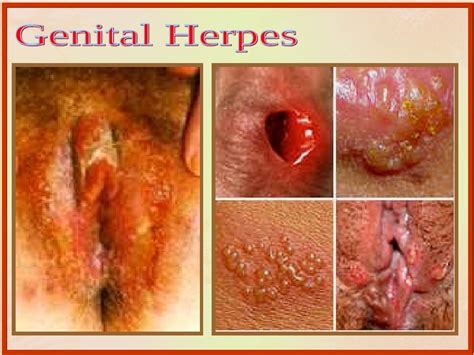 symptoms of oral herpes in men xxx porn library