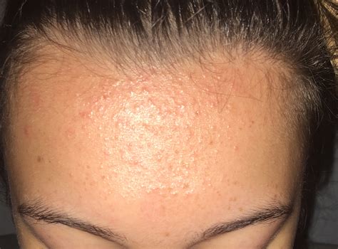 Forehead Bumps Acne Nothing Works – General Acne Discussion – Acne