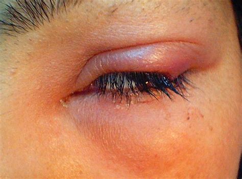 eyelid swelling upper   symptoms treatment home