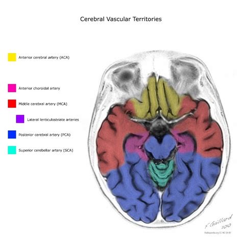 arteria cerebral anterior avc