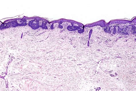 pathology outlines basal cell carcinoma