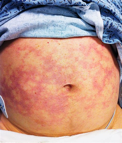 case challenge   year  man  fever confusion thrombocytopenia rash  renal