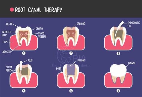 root canal  dental filling bali implant aesthetic bia dental center