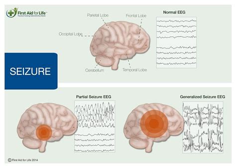 seizures convulsions  epilepsy  complete guide